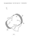 BODILY IMPLANTS AND METHODS OF TREATING FECAL INCONTINENCE USING BODILY     IMPLANTS diagram and image