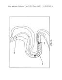 ROTATE-TO-ADVANCE CATHETERIZATION SYSTEM diagram and image