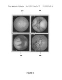 SYSTEM AND METHOD FOR AUTOMATED DISEASE ASSESSMENT IN CAPSULE ENDOSCOPY diagram and image