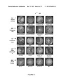 SYSTEM AND METHOD FOR AUTOMATED DISEASE ASSESSMENT IN CAPSULE ENDOSCOPY diagram and image