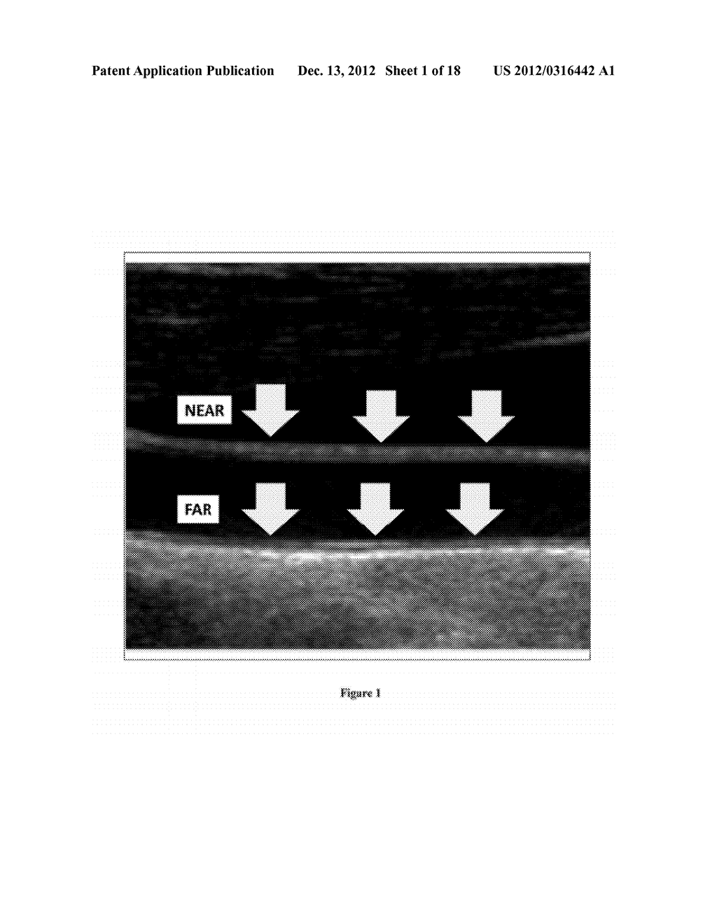 Hypothesis Validation of Far Wall Brightness in Arterial Ultrasound - diagram, schematic, and image 02