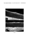 Hypothesis Validation of Far Wall Brightness in Arterial Ultrasound diagram and image