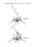 TOOLS FOR PERFORMING LESS INVASIVE ORTHOPEDIC JOINT PROCEDURES diagram and image