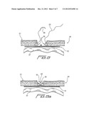 METHOD OF LAPAROSCOPIC HERNIA REPAIR USING SURGICAL MESH diagram and image