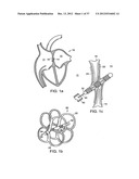 Catching Mechanisms for Tubular Septal Occluder diagram and image