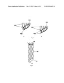 Retrievable covered stent for bifurcation aneurysms diagram and image