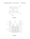 INVASIVE CARDIAC VALVE diagram and image