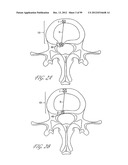 INTERVERTEBRAL DISC REINFORCEMENT SYSTEMS diagram and image