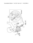 RADIOACTIVE THERAPEUTIC FASTENING INSTRUMENT diagram and image