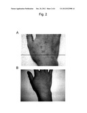 THERAPEUTIC AGENT FOR USE IN A METHOD OF TREATING PSORIASIS OR ATOPIC     DERMATITIS diagram and image