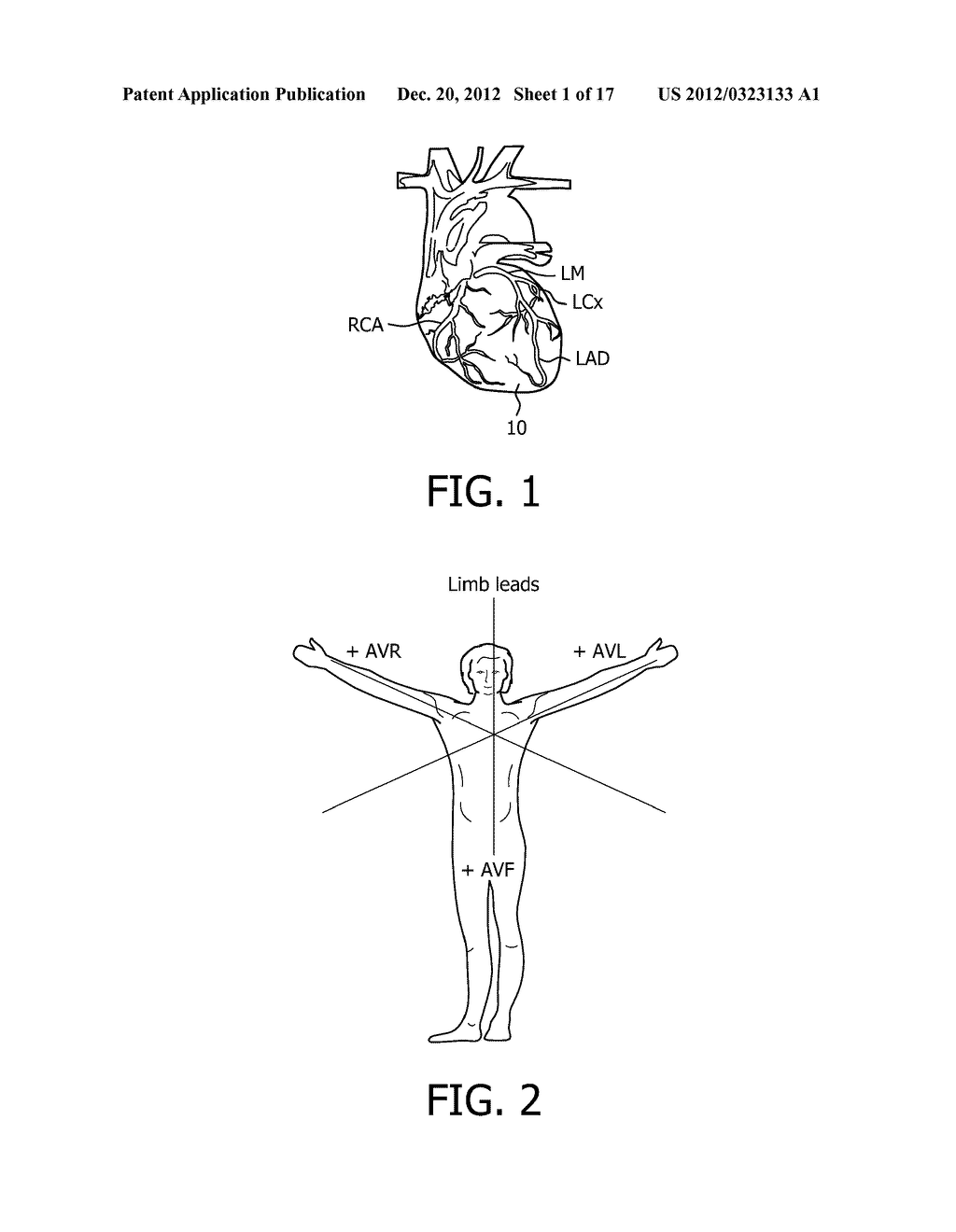 IDENTIFICATION OF CULPRIT CORONARY ARTERY USING ANATOMICALLY ORIENTED ECG     DATA FROM EXTENDED LEAD SET - diagram, schematic, and image 02