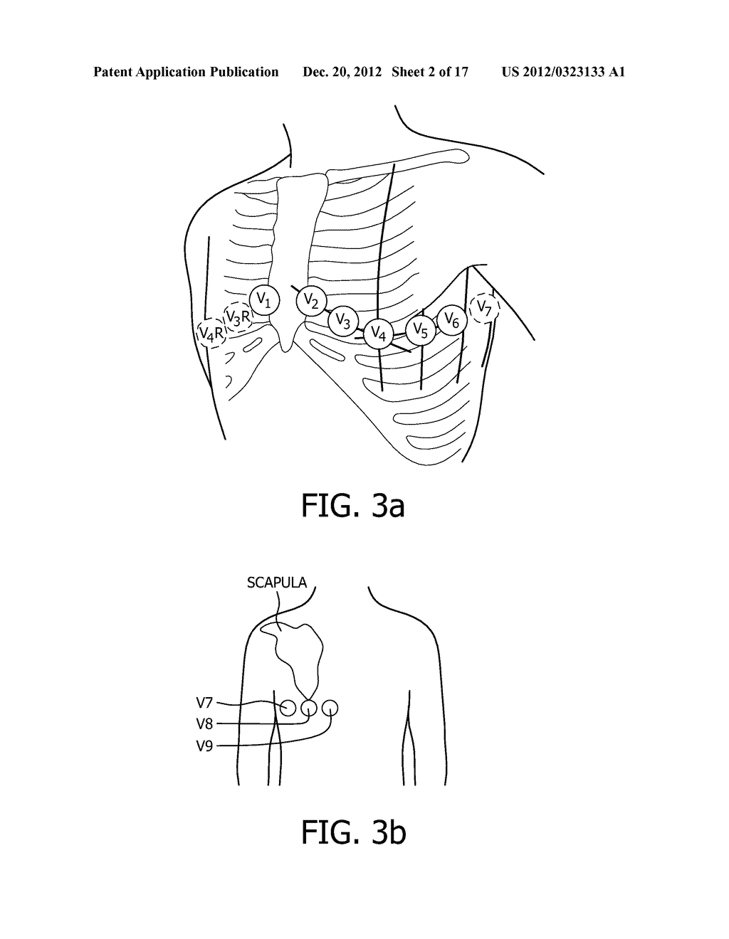 IDENTIFICATION OF CULPRIT CORONARY ARTERY USING ANATOMICALLY ORIENTED ECG     DATA FROM EXTENDED LEAD SET - diagram, schematic, and image 03