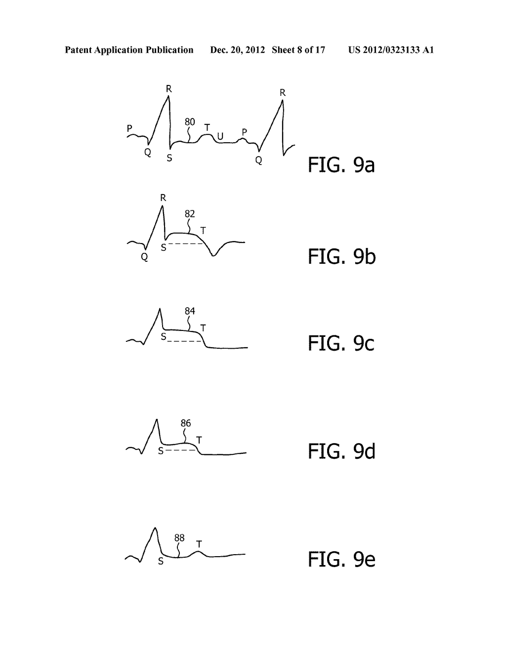 IDENTIFICATION OF CULPRIT CORONARY ARTERY USING ANATOMICALLY ORIENTED ECG     DATA FROM EXTENDED LEAD SET - diagram, schematic, and image 09