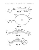 CATHETER ASSEMBLY diagram and image