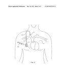 INTERNAL DEVICE FOR INJECTION AND SAMPLING OF A LIQUID INSIDE A LIVING     ORGANISM diagram and image