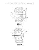 FISTULA CLOSURE DEVICES AND METHODS diagram and image