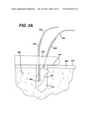 HIGH STRENGTH SUTURE WITH ABSORBABLE CORE AND SUTURE ANCHOR COMBINATION diagram and image