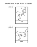 METHOD AND DEVICE FOR APPROXIMATING TISSUE diagram and image