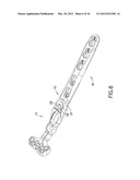 Method of Implanting a Modular Fracture Fixation System diagram and image