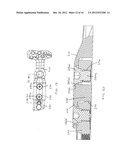 Method of Implanting a Modular Fracture Fixation System diagram and image