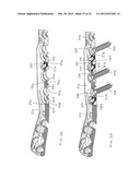 Method of Implanting a Modular Fracture Fixation System diagram and image