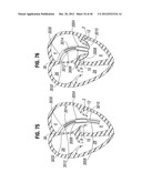 PROSTHETIC APPARATUS FOR IMPLANTATION AT MITRAL VALVE diagram and image