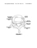 INJECTION OF FIBRIN SEALANT USING RECONSTITUTED COMPONENTS IN SPINAL     APPLICATIONS diagram and image