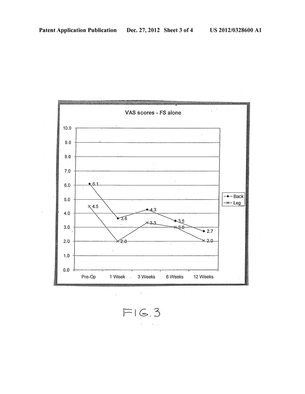 INJECTION OF FIBRIN SEALANT USING RECONSTITUTED COMPONENTS IN SPINAL     APPLICATIONS - diagram, schematic, and image 04