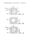 SUBCUTANEOUS CAVITY MARKING DEVICE AND METHOD diagram and image