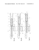 Intramedullary Rod Tracking diagram and image