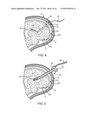 Methods and Apparatus for Removing Blood Clots and Tissue from the     Patient s Head diagram and image