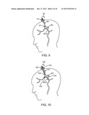 Methods and Apparatus for Removing Blood Clots and Tissue from the     Patient s Head diagram and image