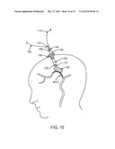 Methods and Apparatus for Removing Blood Clots and Tissue from the     Patient s Head diagram and image