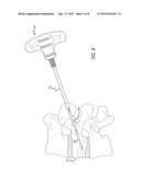 METHOD FOR USING RETRACTABLE STYLET AND CANNULA COMBINATION TO FORM AN     OPENING IN BONE diagram and image