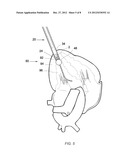 TRANSAPICAL CLOSURE DEVICES AND METHODS FOR USE diagram and image