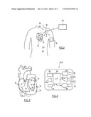 Autonomous (Leadless) Intracardiac Implantable Medical Device With     Releasable Base and Fastener Element diagram and image