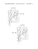 CLOSED BAND FOR PERCUTANEOUS ANNULOPLASTY diagram and image