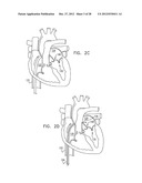 CLOSED BAND FOR PERCUTANEOUS ANNULOPLASTY diagram and image