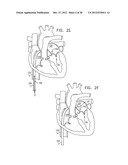 CLOSED BAND FOR PERCUTANEOUS ANNULOPLASTY diagram and image