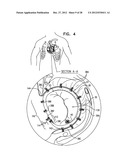 CLOSED BAND FOR PERCUTANEOUS ANNULOPLASTY diagram and image