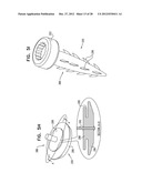 CLOSED BAND FOR PERCUTANEOUS ANNULOPLASTY diagram and image