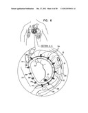 CLOSED BAND FOR PERCUTANEOUS ANNULOPLASTY diagram and image