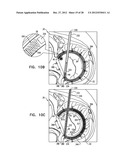 CLOSED BAND FOR PERCUTANEOUS ANNULOPLASTY diagram and image