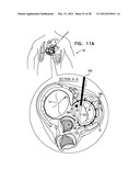 CLOSED BAND FOR PERCUTANEOUS ANNULOPLASTY diagram and image