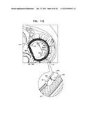 CLOSED BAND FOR PERCUTANEOUS ANNULOPLASTY diagram and image