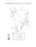 Metal removal system and method diagram and image