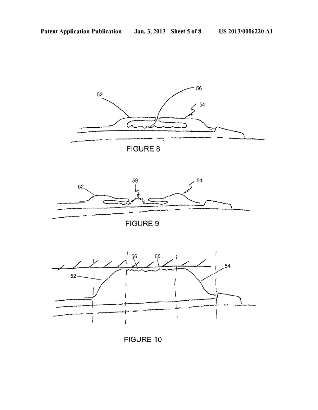 DRUG COATED BALLOON CATHETER - diagram, schematic, and image 06