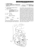 CATHETER WITH VARIABLE ARCUATE DISTAL SECTION diagram and image