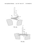 CATHETER WITH VARIABLE ARCUATE DISTAL SECTION diagram and image