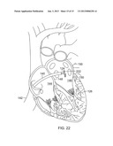 CATHETER WITH VARIABLE ARCUATE DISTAL SECTION diagram and image